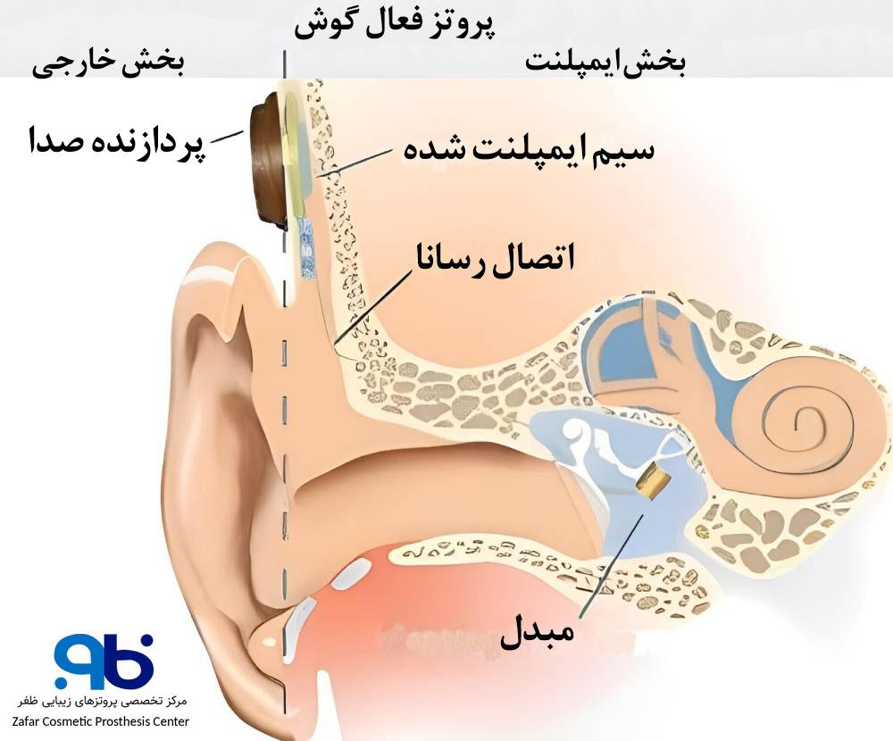 پروتز گوش میانی فعال