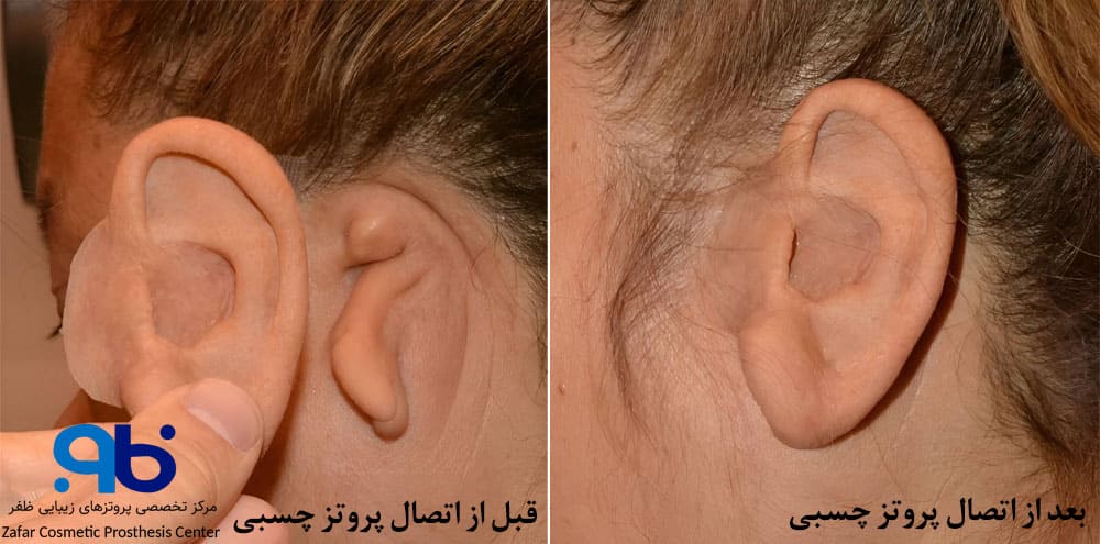 پروتزهای چسبی گوش