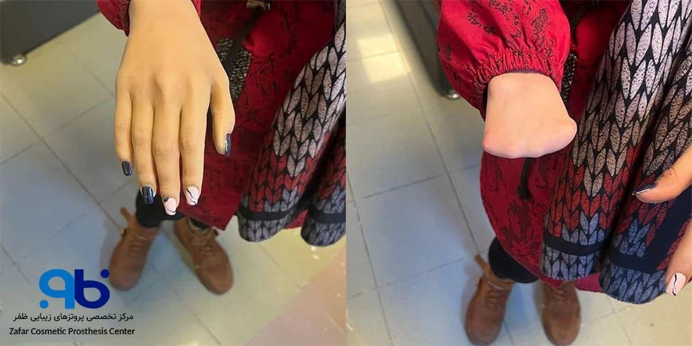 با پروتز غیرفعال و داشتن ظاهر زیباتر