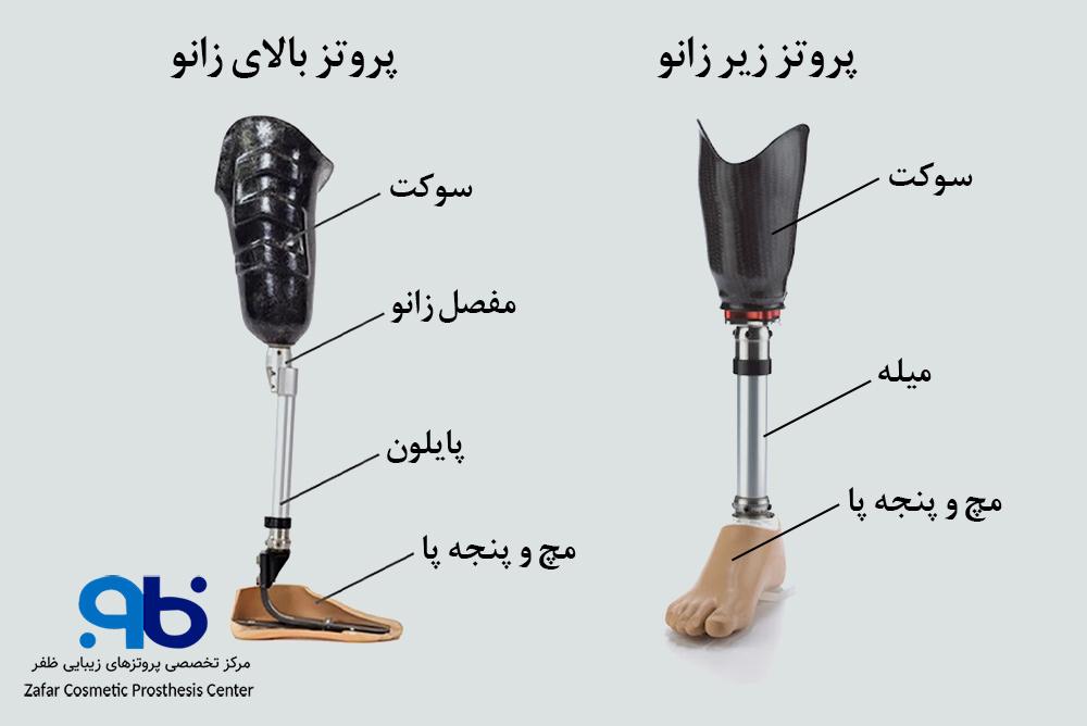 اجزای پروتز زانو