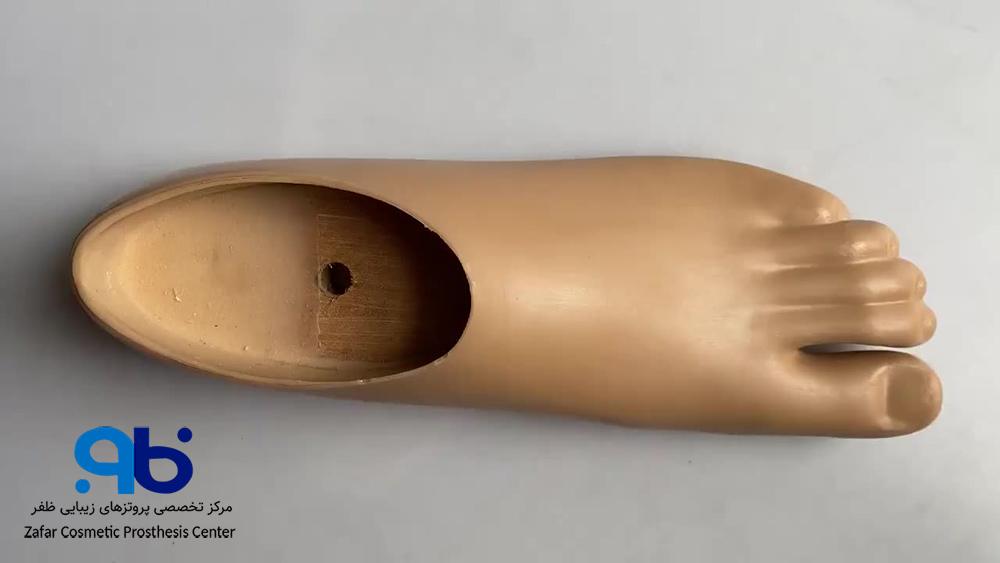 پنجه پای سایم (Syme Foot)