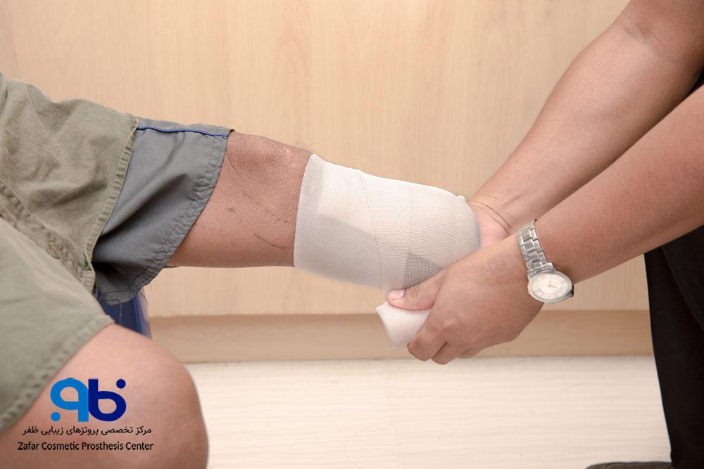 مدیریت ورم و فرمدهی به اندام قطع شده