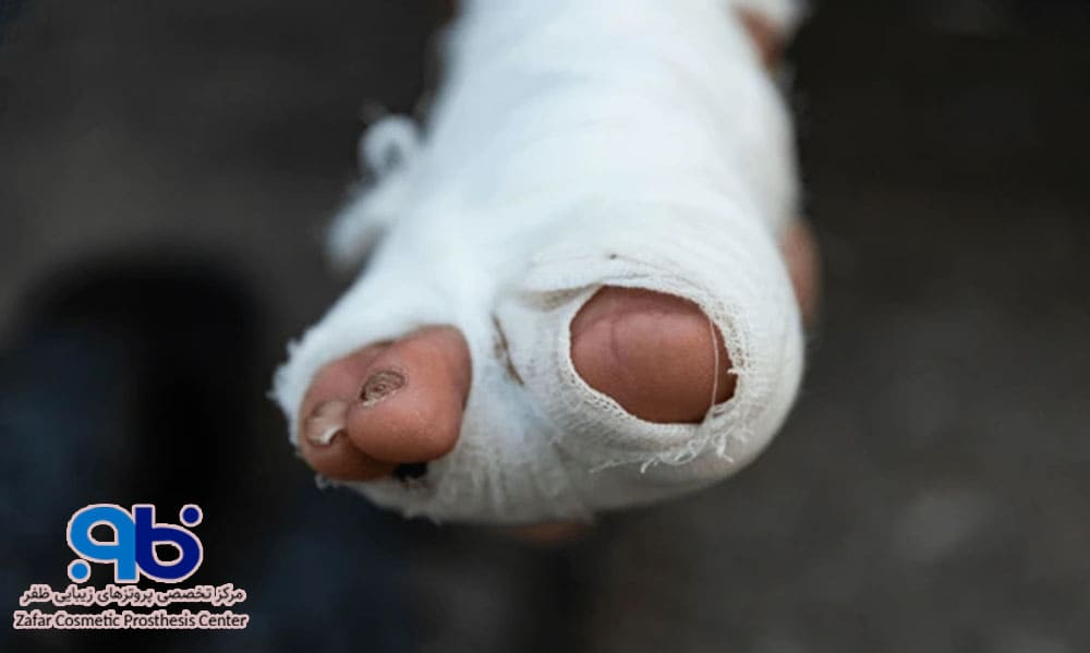 تعویض منظم پانسمان و تمیز نگه داشتن زخم