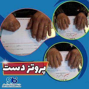 پروتز دست مصنوعی با ظاهری طبیعی