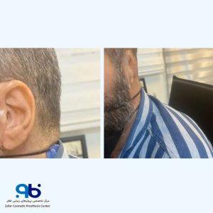 طراحی و ساخت بهترین پروتزها