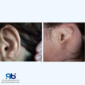 طراحی و ساخت بهترین و باکیفیتترین پروتزها