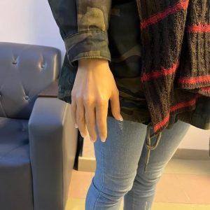ساخت پروتز دست