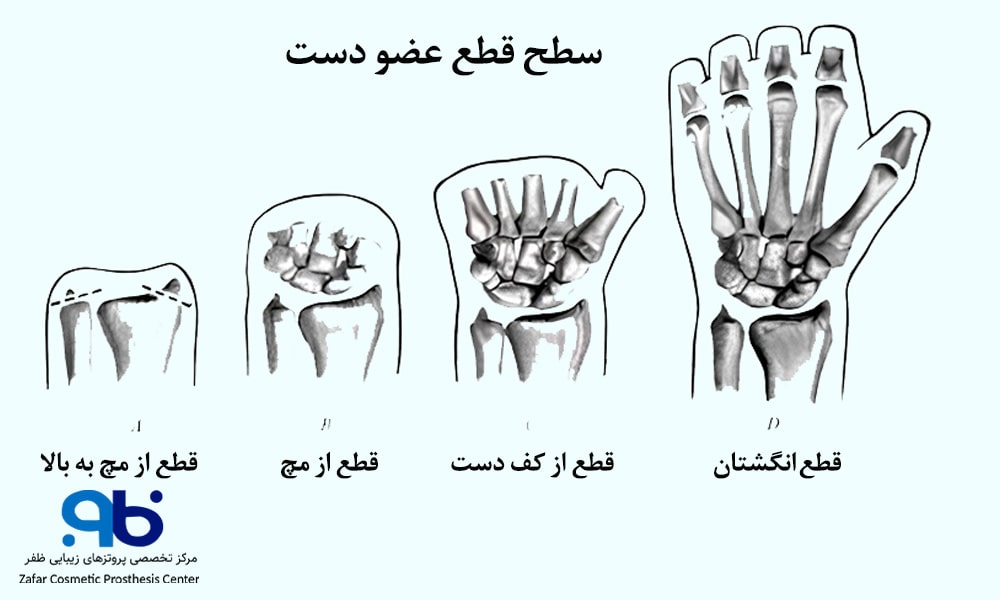 سطح قطع عضو دست