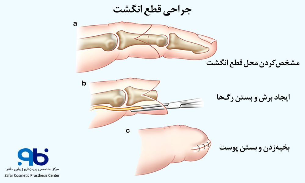 جراحی قطع انگشت