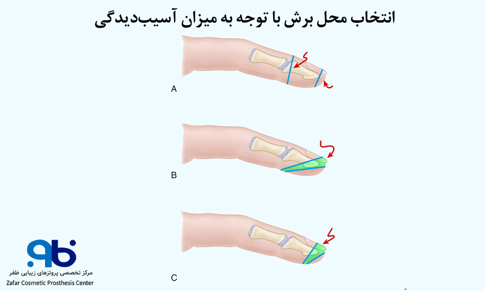 محل قطع انگشت