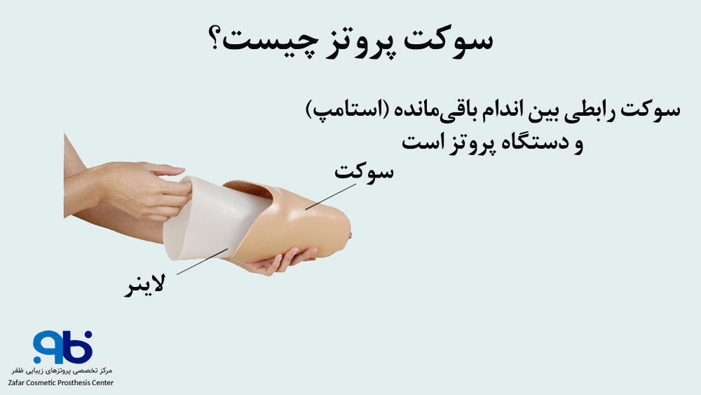 روش اتصال پروتز پنجه سایم