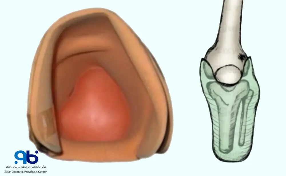 سوکت وزنگیر از تاندون پاتلار