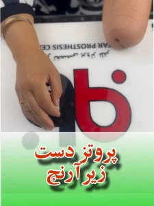 پروتز زیبایی
