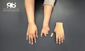 پروتز دست